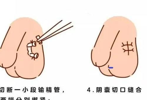 男性结扎（探讨男性结扎对家庭生活的影响及应对之策）